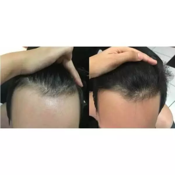 resultados do minoxidil kirkland parte da frente do cabelo